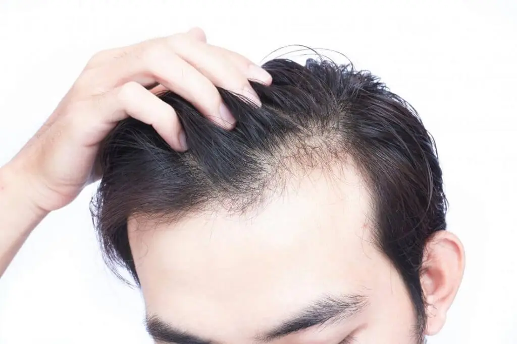 تساقط الشعر مشكلة جدية لعدد كبير من الرجال وحتى لبعض النساء
