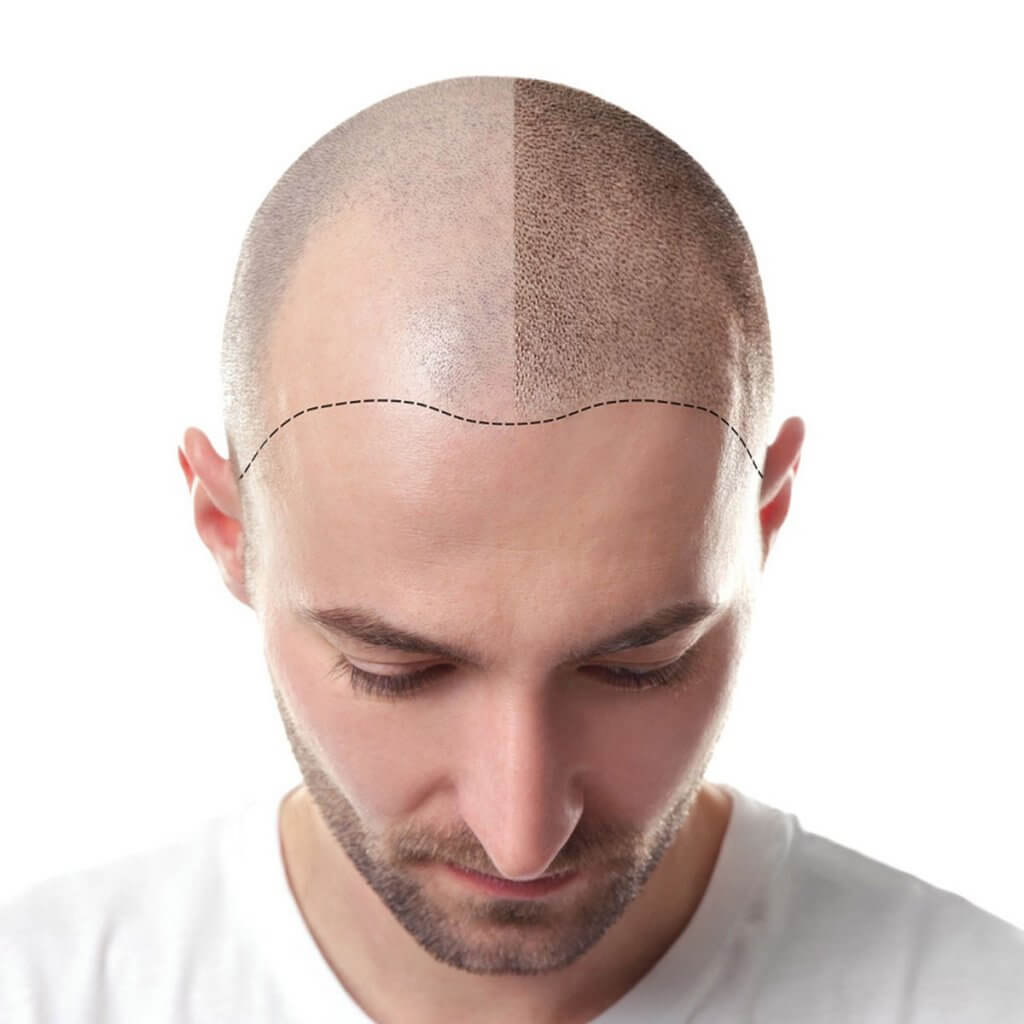 زراعة الشعر في شيراز
