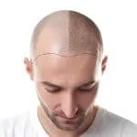 زراعة الشعر في مدينة شيراز ايران 🇮🇷 | المميزات والطرق والتكلفة واهم المعلومات 6 زراعة الشعر في شيراز