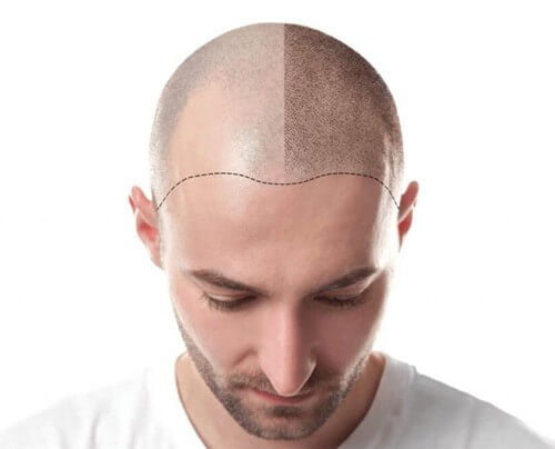 زراعة الشعر في ايران