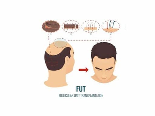 طريقة الشريحة FUT مقابل طريقة الاقتطاف FUE في زراعة الشعر 3