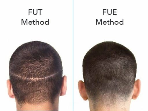 طريقة الشريحة FUT مقابل طريقة الاقتطاف FUE في زراعة الشعر 5