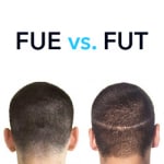 طريقة الشريحة FUT مقابل طريقة الاقتطاف FUE في زراعة الشعر 2