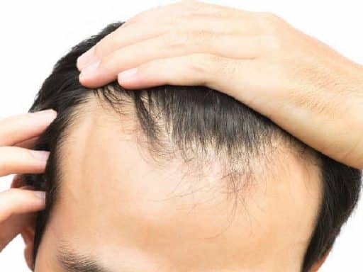 طريقة الشريحة FUT مقابل طريقة الاقتطاف FUE في زراعة الشعر 1