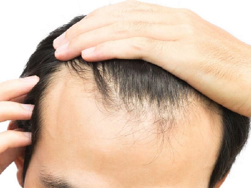 نصائح قبل عملية زراعة الشعر