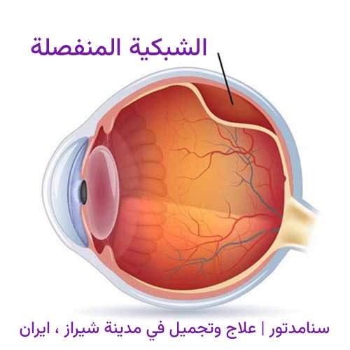 طرق إزالة زيت السليكون بعد عملية انفصال الشبكية 1