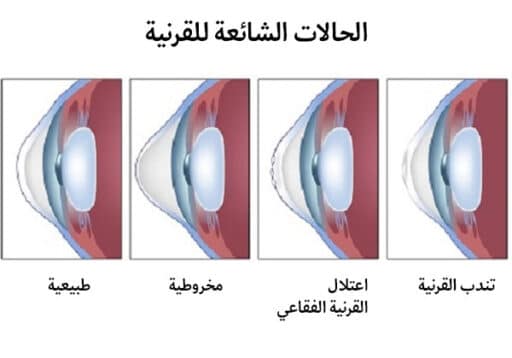 زراعة القرنية