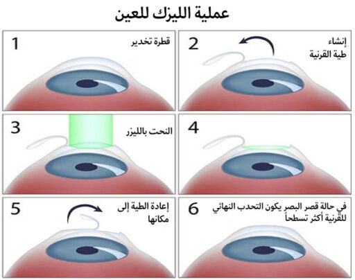 خطوات عملية الليزك