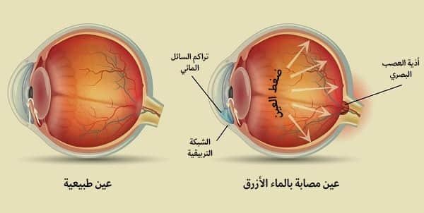 عملية الماء الأزرق في إيران 1