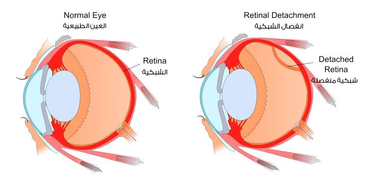 الالم بعد عمليه انفصال الشبكيه وحقن السيليكون في العين 6 الالم بعد عمليه انفصال الشبكيه وحقن السيليكون في العين
