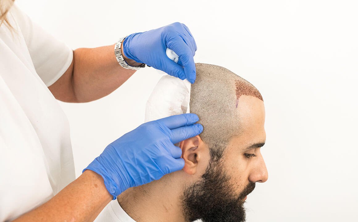 تعليمات ونصائح لما بعد زراعة الشعر