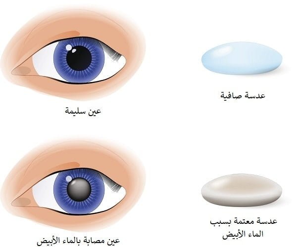 سحب الماء الابيض في ايران 1