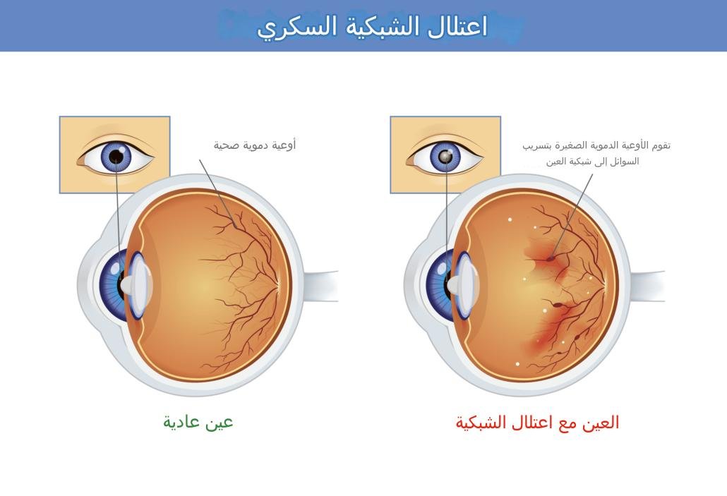 علاج اعتلال الشبكية السكريفي ايران 1