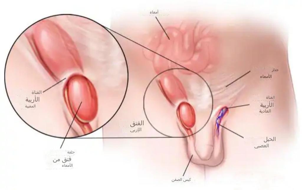 عملية فتق البطن Hernia repair 1