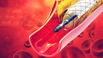 القسطرة العلاجية في ايران | افضل دكتور ومستشفى وتكلفة | سنا مدتور 1