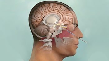 علاج الأكياس العنكبوتية في ايران