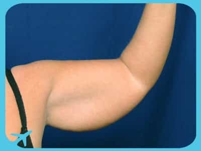 شد الذراعين في ايران | افضل دكتور تجميل ومستشفى وتكلفة | سنا مدتور 3 شد الذراعين في ايران مع سنا مدتور