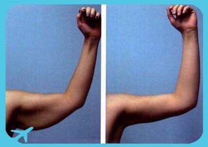 شد الذراعين في ايران | افضل دكتور تجميل ومستشفى وتكلفة | سنا مدتور 4 قبل وبعد عملية شد الذراعين