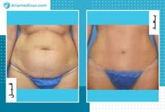 تعليمات للشفاء السريع بعد شفط الدهون: المسموحات والممنوعات