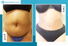 انقاص الوزن في ايران بالمنظار | أفضل نتيجة تنحيف وتكلفة | سنا مدتور 2