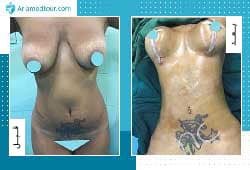 انقاص الوزن في ايران بالمنظار | أفضل نتيجة تنحيف وتكلفة | سنا مدتور 3