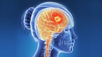 علاج السرطان في ايران | أفضل المشافي بتكاليف معقولة | سنا مدتور 1