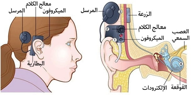زراعة القوقعة في ايران | استعادة السمع و علاج ضعف السمع بأنسب سعر 6 جراحة زراعة القوقعة