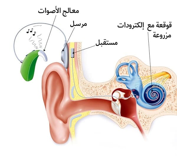 زراعة القوقعة في ايران | استعادة السمع و علاج ضعف السمع بأنسب سعر 3 زراعة القوقعة في ايران