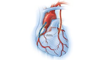 Coronary-artery-bypass عملية القلب في ايران لدى أشهر الجراحين بأنسب الأسعار | سنا مدتور 4