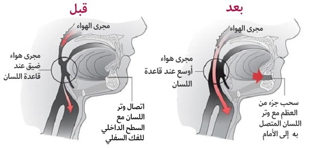 علاج انقطاع النفس النومي في ايران | افضل اطباء و مشافي و اسعار 6 انقطاع النفس النومي - تقديم العضلة الذقنية اللسانية