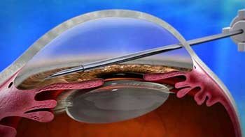 طب العيون في ايران | افضل دكتور ومستشفى ونتائج وتكلفة | سنا مدتور 8