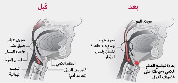 علاج انقطاع النفس النومي في ايران | افضل اطباء و مشافي و اسعار 7 تعليق العظم اللامي لمعالجة انقطاع النفس النومي