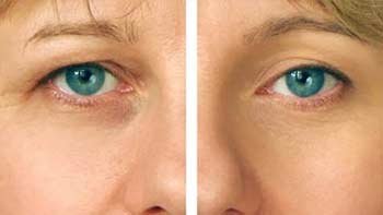 طب العيون في ايران | افضل دكتور ومستشفى ونتائج وتكلفة | سنا مدتور 12