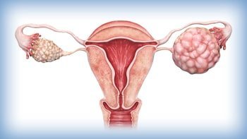 علاج سرطان المبيض في ايران
