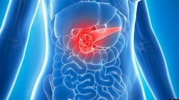 علاج سرطان البنكرياس في ايران