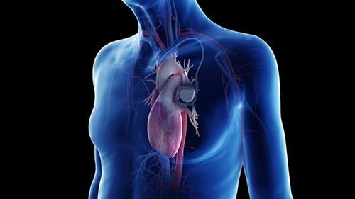 تركيب جهاز تنظيم ضربات القلب في ايران | أفضل دكتور وتكلفة | سنا مدتور 1