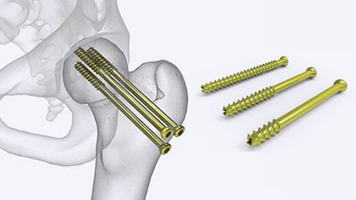 جراحة العظام والمفاصل في ايران | افضل دكتور وتكلفة | سنا مدتور 3 جراحة العظام والمفاصل في ايران | افضل دكتور وتكلفة | سنا مدتور 10