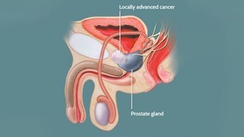 علاج سرطان البروستات في ايران