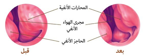 علاج انقطاع النفس النومي في ايران | افضل اطباء و مشافي و اسعار 5 انقطاع النفس النومي - رأب المحارات الأنفية