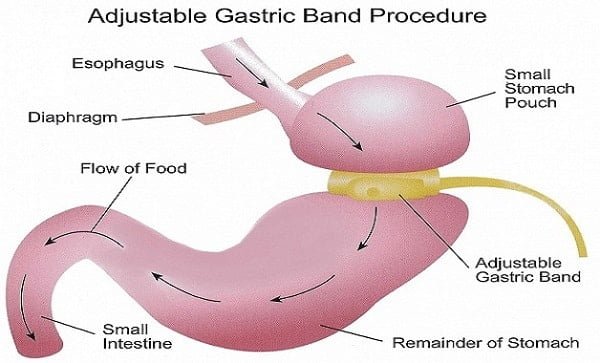 آلية ربط المعدة