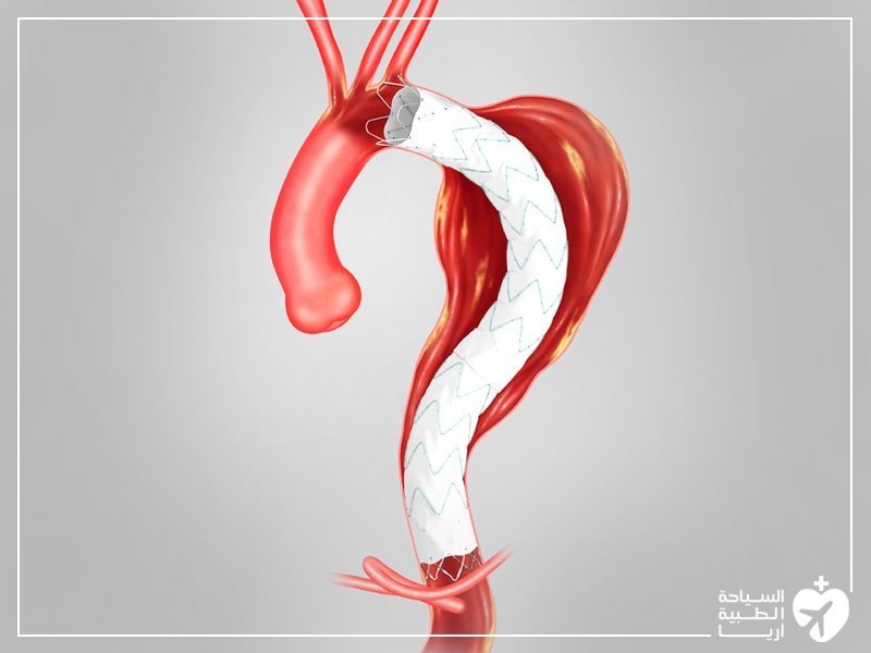 عملية ام الدم الابهرية في ايران | افضل دكتور ومستشفى وتكلفة | سنا مدتور 3 عملية ام الدم الابهرية في ايران