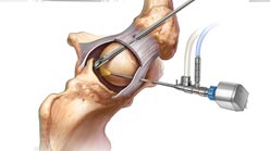 تنضير مفصل الركبة بالمنظار تنضير مفصل الركبة بالمنظار في ايران