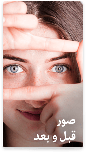 جراحة إزالة كيس العين في إيران | كيفية إزالة أكياس العين نهائياً - سنا مدتور 1