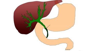 جراحة القنوات الصفراوية في ايران