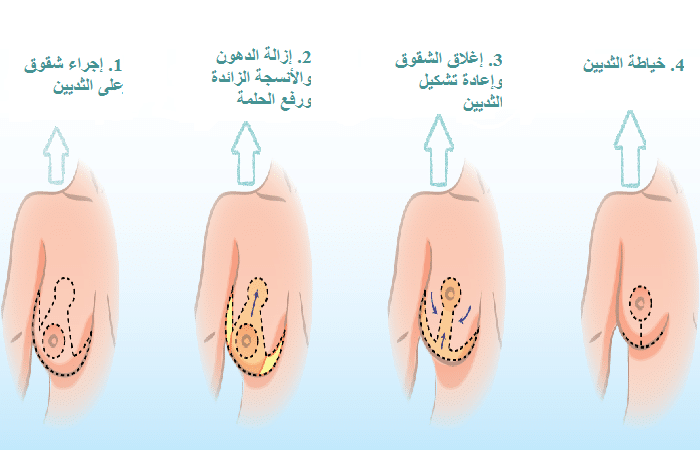 كيفية إجراء تصغير الثدي في ايران