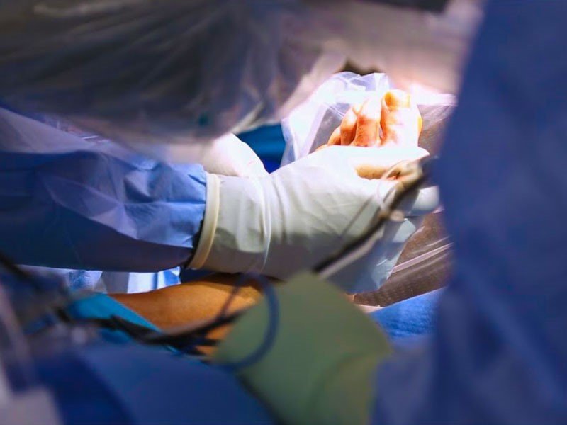 عملية ورم ابهام القدم في ايران