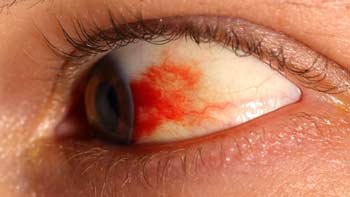 طب العيون في ايران | افضل دكتور ومستشفى ونتائج وتكلفة | سنا مدتور 13