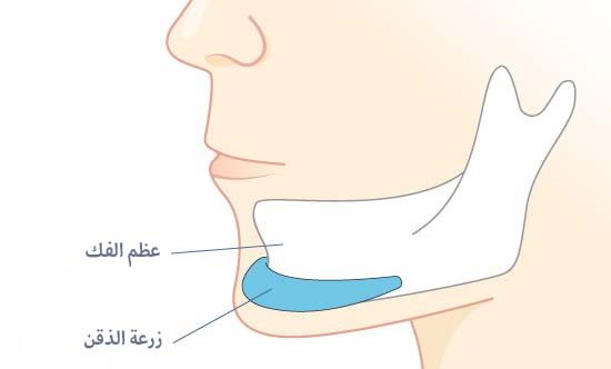 تجميل الذقن بزراعة العظم