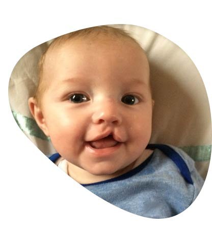 الشفة الارنبية