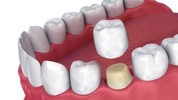 جسور الاسنان في ايران